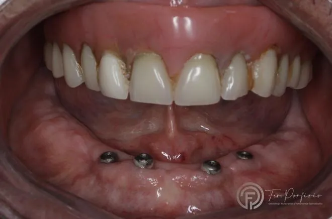 Arcada inferior com os implantes instalados e intermediários expostos