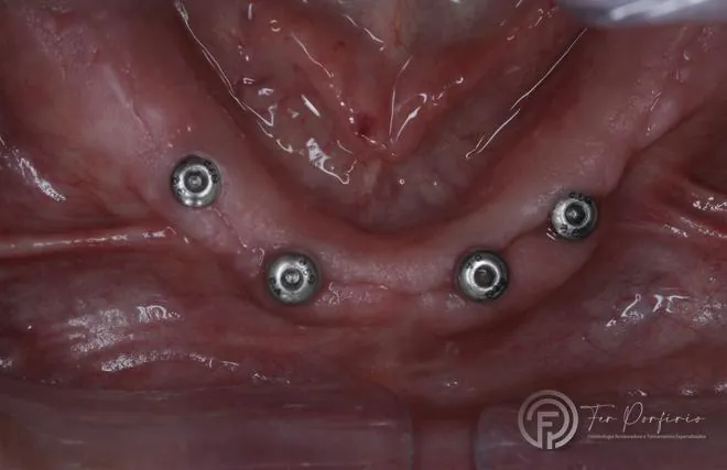 Vista aproximada dos cinco intermediários sobre os implantes