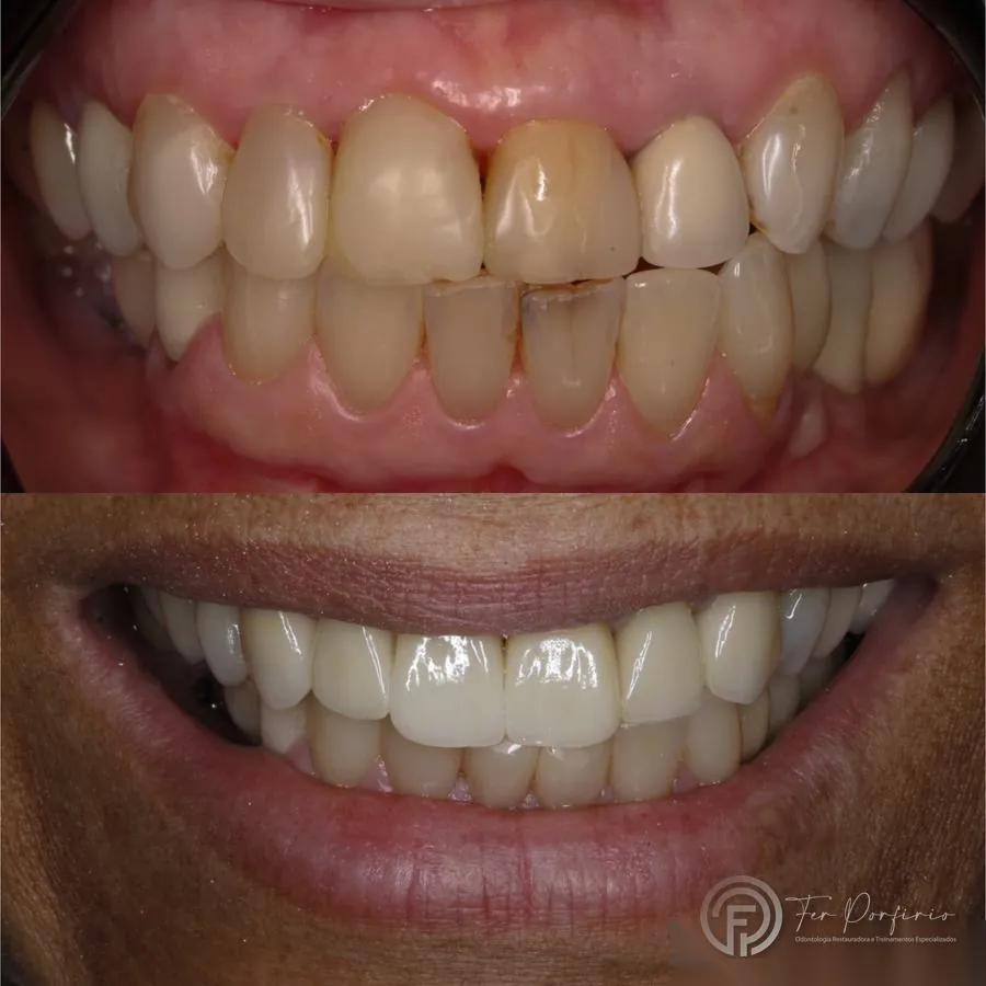 Registro de diagnóstico e resultado de reabilitação oral em cerâmica nas arcadas superior e inferior