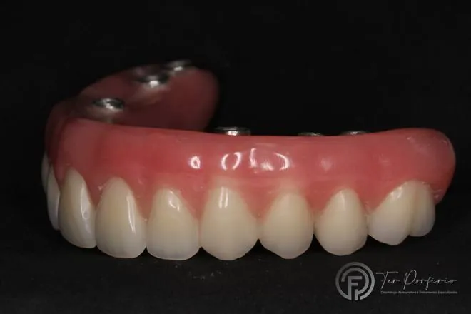 Prótese do protocolo mostrando os canais de fixação sobre os implantes