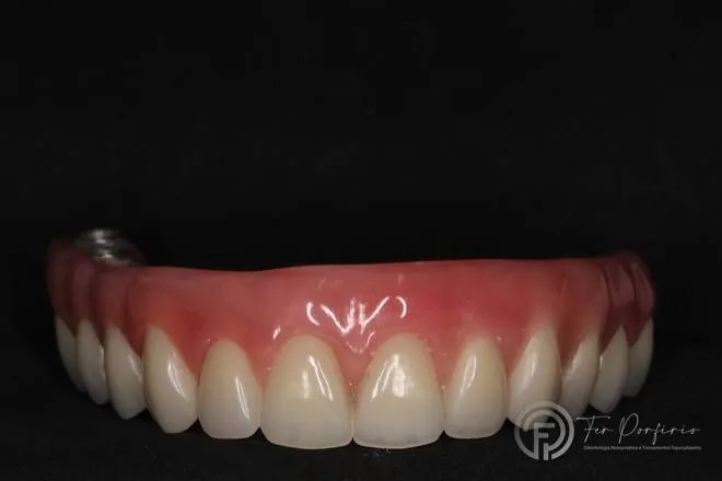 Prótese do protocolo em vista frontal, antes da instalação